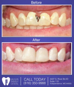 cosmetic bonding tooth colored fillings vaughn family dental
