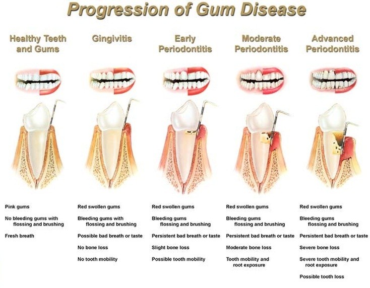 progression-of-gum-disease--Vaughn-Family-Dental-Best-Dentist-in-Independence-Missouri-MO