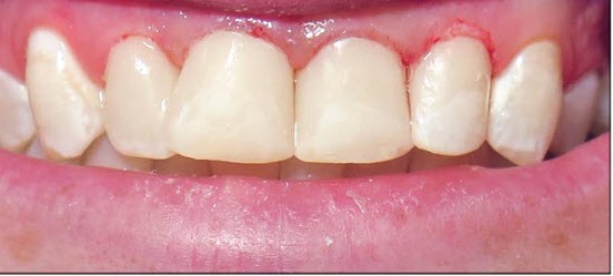 VAUGHN_FAMILY_DENTAL_SERVICE_COSMETIC_BONDING_AFTER--Vaughn-Family-Dental-Best-Dentist-in-Independence-Missouri-MO