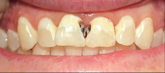 VAUGHN_FAMILY_DENTAL_SERVICE_COSMETIC_BONDING_BEFORE